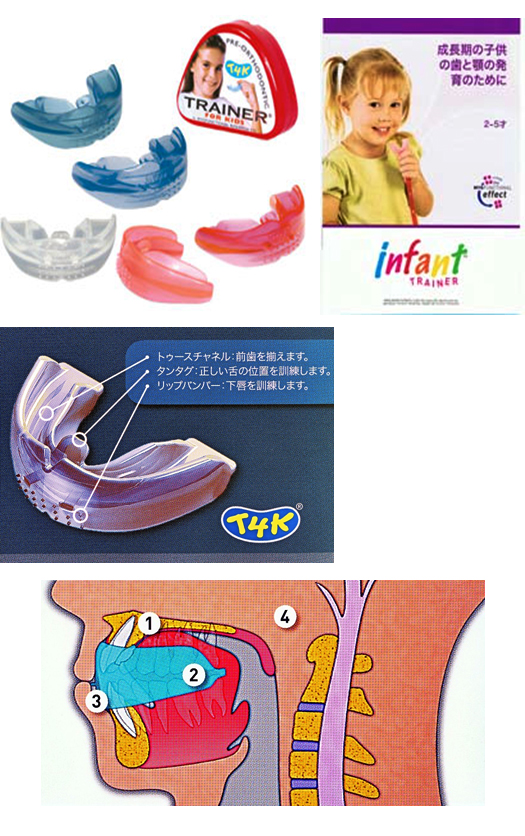 乳歯列期及び混合歯列期の叢生、前突、交叉、過蓋咬合治療
