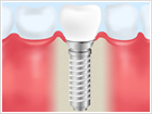 インプラント