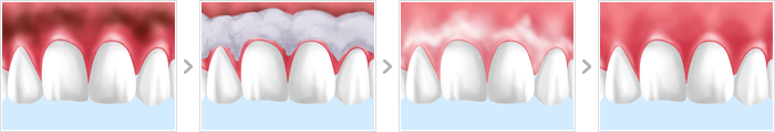 歯ぐきのホワイトニング